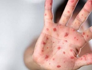 M çiçeği uyarısı: Çocuklar daha kolay bulaş kaynağına maruz kalabilir