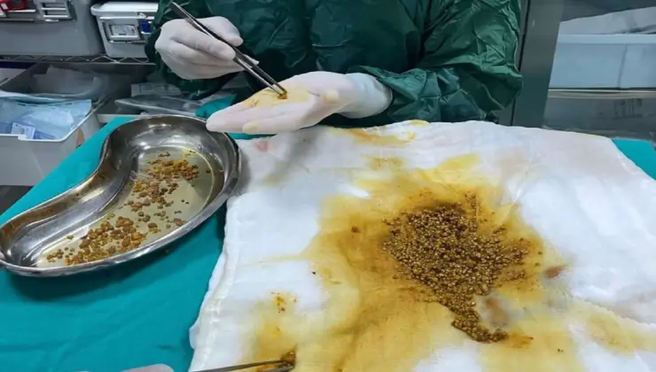 Karın ağrısıyla başvurdu, safra kesesinden 2 bin 67 taş çıktı!