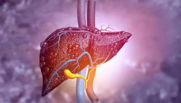 Uzmanlar uyarıyor: 2050 yılına kadar 1,8 milyar insanı etkileyecek karaciğer hastalığı!